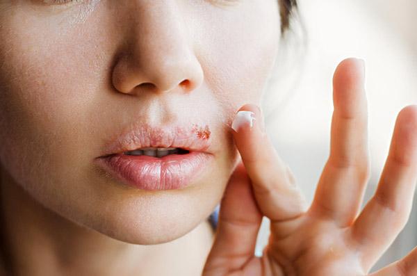 Herpes Labial O Que Quais S O Os Sintomas E Como Evitar Greenme